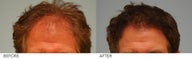 Hair Transplant 