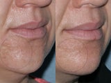 Acne Scars Treatment