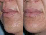 Fraxel Repair for acne scars