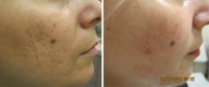 Acne Scars Treatment