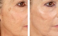 Active FX Fractional Laser Resurfacing