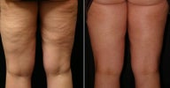 Acoustic Wave Therapy  to Thighs
