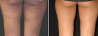 Acoustic Wave Therapy  to Thighs