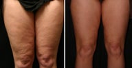 Accoustic Wave Therapy to front of legs
