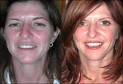 FX Laser Peel, Botox