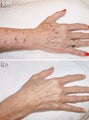 Age spots and sun damage IPL treatment