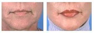 Lip augmentation with Alloderm implants