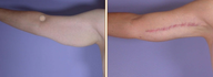 Arm Lift