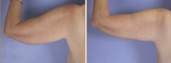 Arm Lift