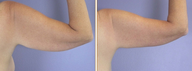 Arm Lift