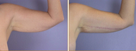 Arm Lift