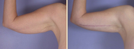 Arm Lift