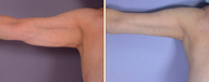Arm Lift