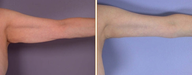 Arm Lift