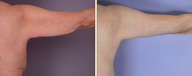 Arm Lift