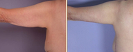 Arm Lift