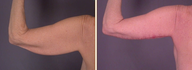 Arm Lift
