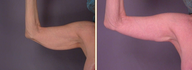 Arm Lift