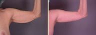 Arm Lift