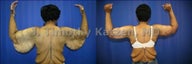 Before and after picture arm lift arm reduction after massive weight loss gastric bypass female african american back view 