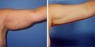 Arm Liposuction