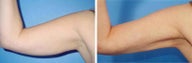 Arm Liposuction