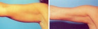 Arm Liposuction