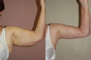 Arm Lift (Brachioplasty)