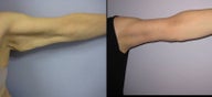 Brachioplasty - Arm Lift
