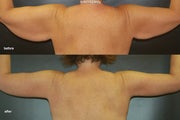 Brachioplasty