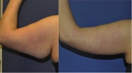 Arm Lift
