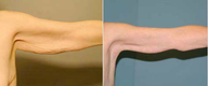 Arm Lift