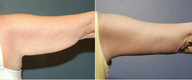 Arm Lift