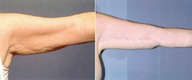 Arm Lift