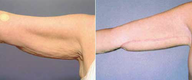 Arm Lift