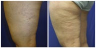 spider vein sclerotherapy with asclera