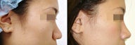 Rhinoplasty