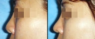 Rhinoplasty
