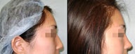 Rhinoplasty