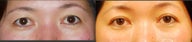 Female Double Eyelid 