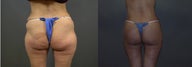 Body Lift
