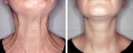 Botox for platysmaplasty 