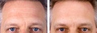 Botox Cosmetic