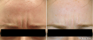 Botox