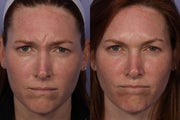 Botox