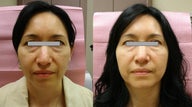 Botox