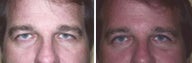 Botox Cosmetic