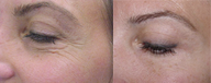 Botox 