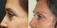 Crows Feet