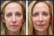 Botox & Juvederm